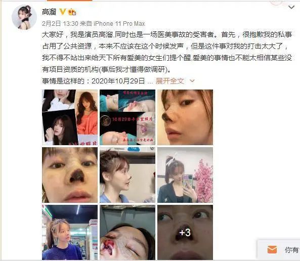女演员自曝整容失败噩梦：面临毁容、丢了工作还要赔200万违约金！